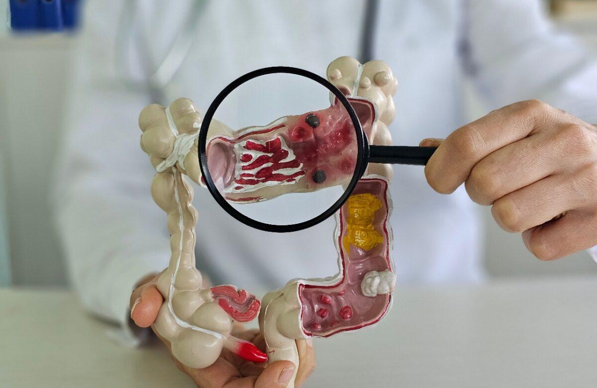 PREDICCIÓN PARA ESTIMAR EL RIESGO DE CÁNCER COLORRECTAL DE INICIO TEMPRANO Y PÓLIPOS PRECANCEROSOS