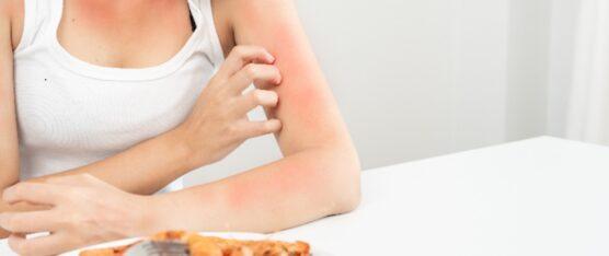 ALERGIA ALIMENTARIA VS. INTOLERANCIA: ¿CUÁL ES LA DIFERENCIA?